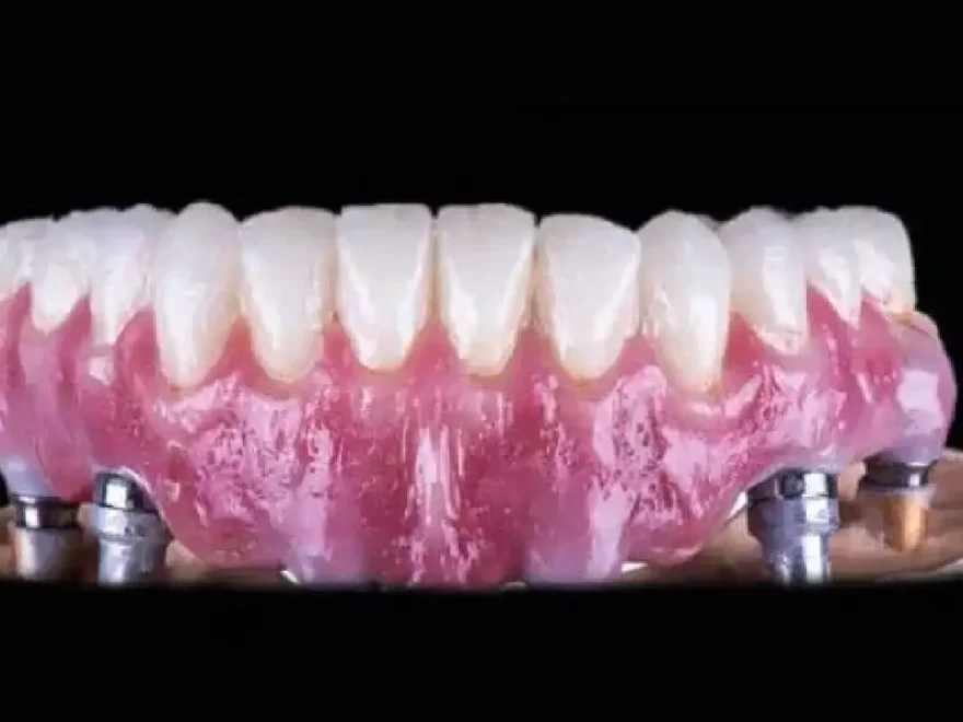 Immediate Implants Vs. Traditional Implants - Which Wins?